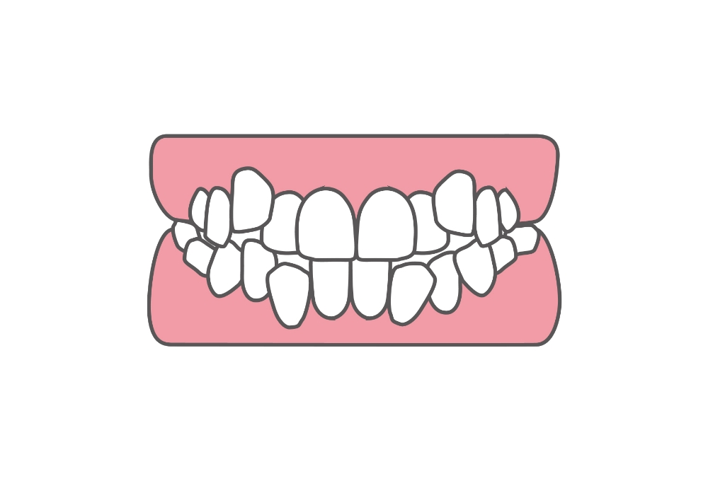 叢生(そうせい)