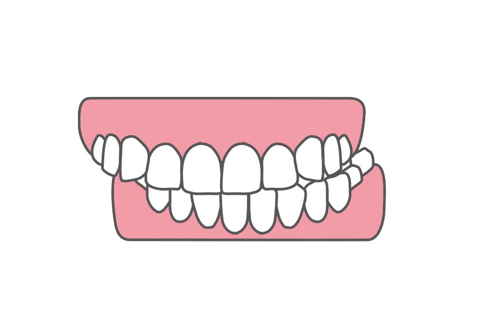 交叉咬合(こうさこうごう)